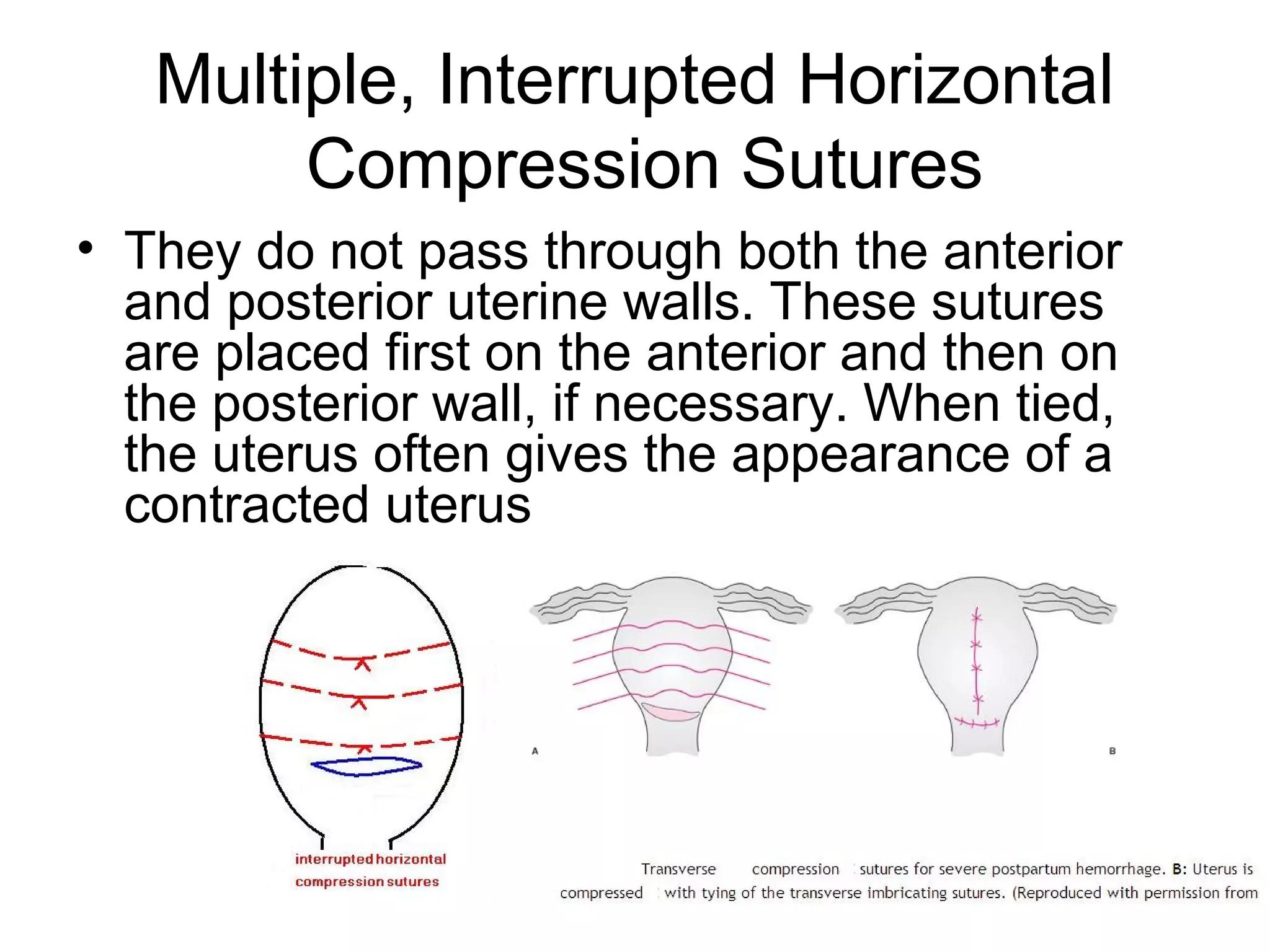 Uterine compression sutures | PPT