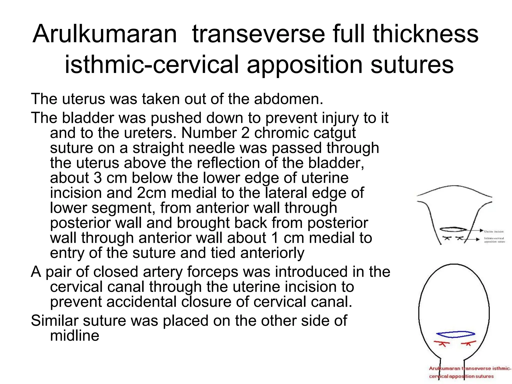 Uterine compression sutures | PPT
