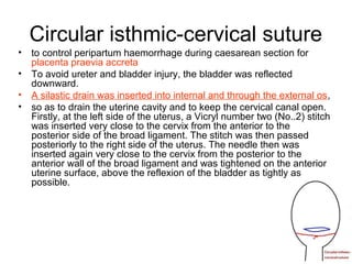 Circular isthmic-cervical suture
• to control peripartum haemorrhage during caesarean section for
placenta praevia accreta
• To avoid ureter and bladder injury, the bladder was reflected
downward.
• A silastic drain was inserted into internal and through the external os,
• so as to drain the uterine cavity and to keep the cervical canal open.
Firstly, at the left side of the uterus, a Vicryl number two (No..2) stitch
was inserted very close to the cervix from the anterior to the
posterior side of the broad ligament. The stitch was then passed
posteriorly to the right side of the uterus. The needle then was
inserted again very close to the cervix from the posterior to the
anterior wall of the broad ligament and was tightened on the anterior
uterine surface, above the reflexion of the bladder as tightly as
possible.
 