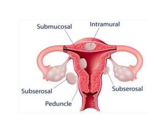 Uterine Fibroid.pptx