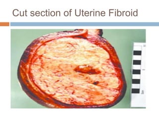 Cut section of Uterine Fibroid
 