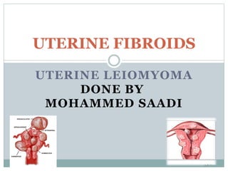 UTERINE LEIOMYOMA
DONE BY
MOHAMMED SAADI
UTERINE FIBROIDS
 