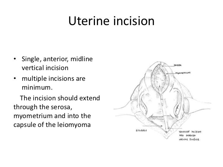 Uterine fibroids