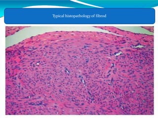Typical histopathologyof fibrod
 
