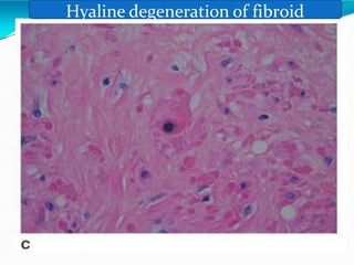 Hyaline degeneration of fibroid
 