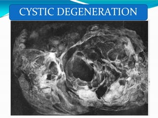 CYSTIC DEGENERATION
 