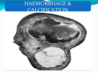HAEMORRHAGE &
CALCIFICATION
 