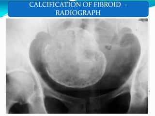 CALCIFICATION OF FIBROID -
RADIOGRAPH
 