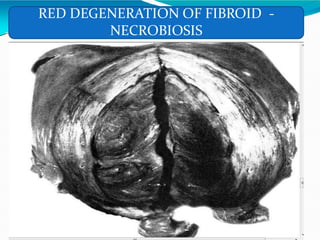 RED DEGENERATION OF FIBROID -
NECROBIOSIS
 