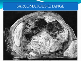 SARCOMATOUS CHANGE
 