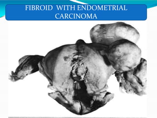 FIBROID WITH ENDOMETRIAL
CARCINOMA
 