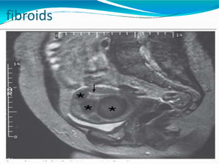 fibroids
 