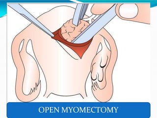 OPEN MYOMECTOMY
 