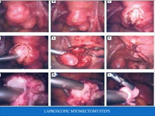 LAPROSCOPIC MYOMECTOMY STEPS
 