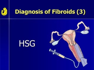 Diagnosis of Fibroids (3)
HSG
 