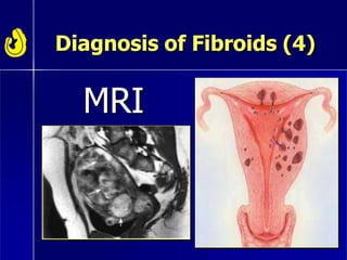 Diagnosis of Fibroids (4)
MRI
 