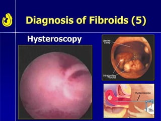 Diagnosis of Fibroids (5)
Hysteroscopy
 