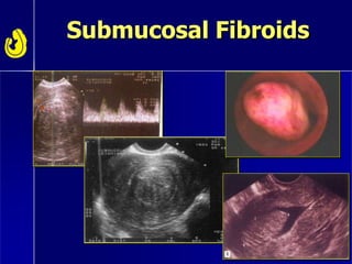 Submucosal Fibroids
 