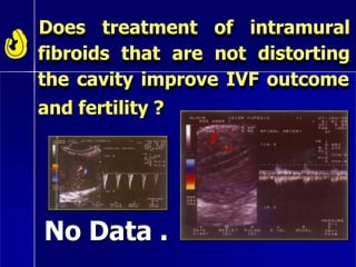 Does treatment of intramural
fibroids that are not distorting
the cavity improve IVF outcome
and fertility ?
No Data .
 