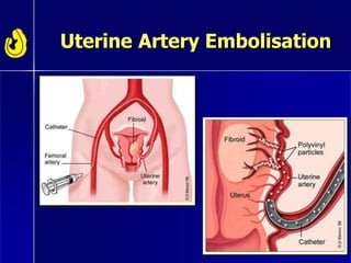 Uterine Artery Embolisation
 