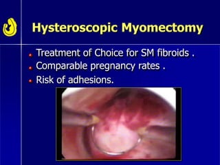 Hysteroscopic Myomectomy
Treatment of Choice for SM fibroids .
Comparable pregnancy rates .
Risk of adhesions.
 