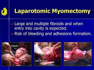Laparotomic Myomectomy
Large and multiple fibroids and when
entry into cavity is expected.
Risk of bleeding and adhesions formation.
 