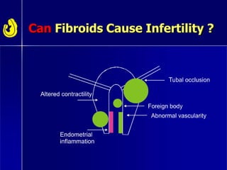 Can Fibroids Cause Infertility ?
 