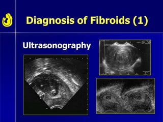 Diagnosis of Fibroids (1)
Ultrasonography
 