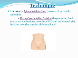 Technique
 Incision - Pfannelstiel incision (uterus <16 -20 weeks
&mobile)
- Vertical paramedian incision (large uterus, fixed
uterus with adhesions, associated PID and endometriosis)
Incision over the anterior abdominal wall
 