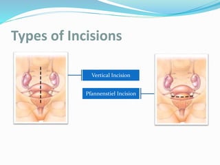 Types of Incisions
Vertical Incision
Pfannenstiel Incision
 