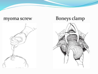 myoma screw Boneys clamp
 