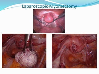 Laparoscopic Myomectomy
 