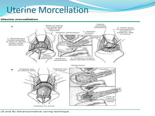 Uterine Morcellation
 
