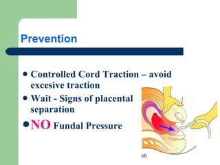 Prevention Controlled Cord Traction – avoid excesive traction Wait - Signs of placental separation NO Fundal Pressure