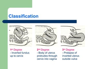 Classification 1 st Degree - Inverted fundus up to cervix 2 nd Degree - Body of uterus protrudes through cervix into vagina 3 rd Degree - Prolapse of inverted uterus outside vulva
