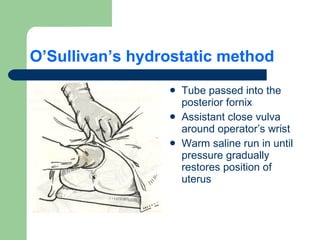O’Sullivan’s hydrostatic method Tube passed into the posterior fornix Assistant close vulva around operator’s wrist Warm saline run in until pressure gradually restores position of uterus