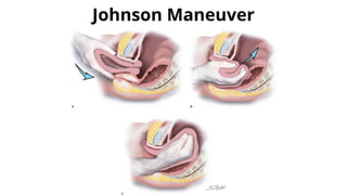 Uterine inversion in obstetrics, procedure | PPTX
