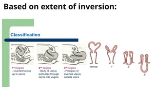 Uterine inversion in obstetrics, procedure | PPTX