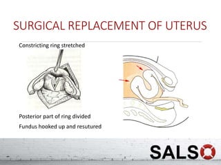 SURGICAL REPLACEMENT OF UTERUS
Constricting ring stretched
Posterior part of ring divided
Fundus hooked up and resutured
 