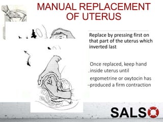 MANUAL REPLACEMENT
OF UTERUS
Replace by pressing first on
that part of the uterus which
inverted last
Once replaced, keep hand
inside uterus until
ergometrine or oxytocin has
produced a firm contraction
 