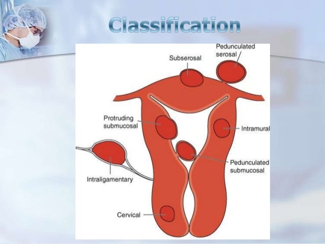 Uterine leiomyomas