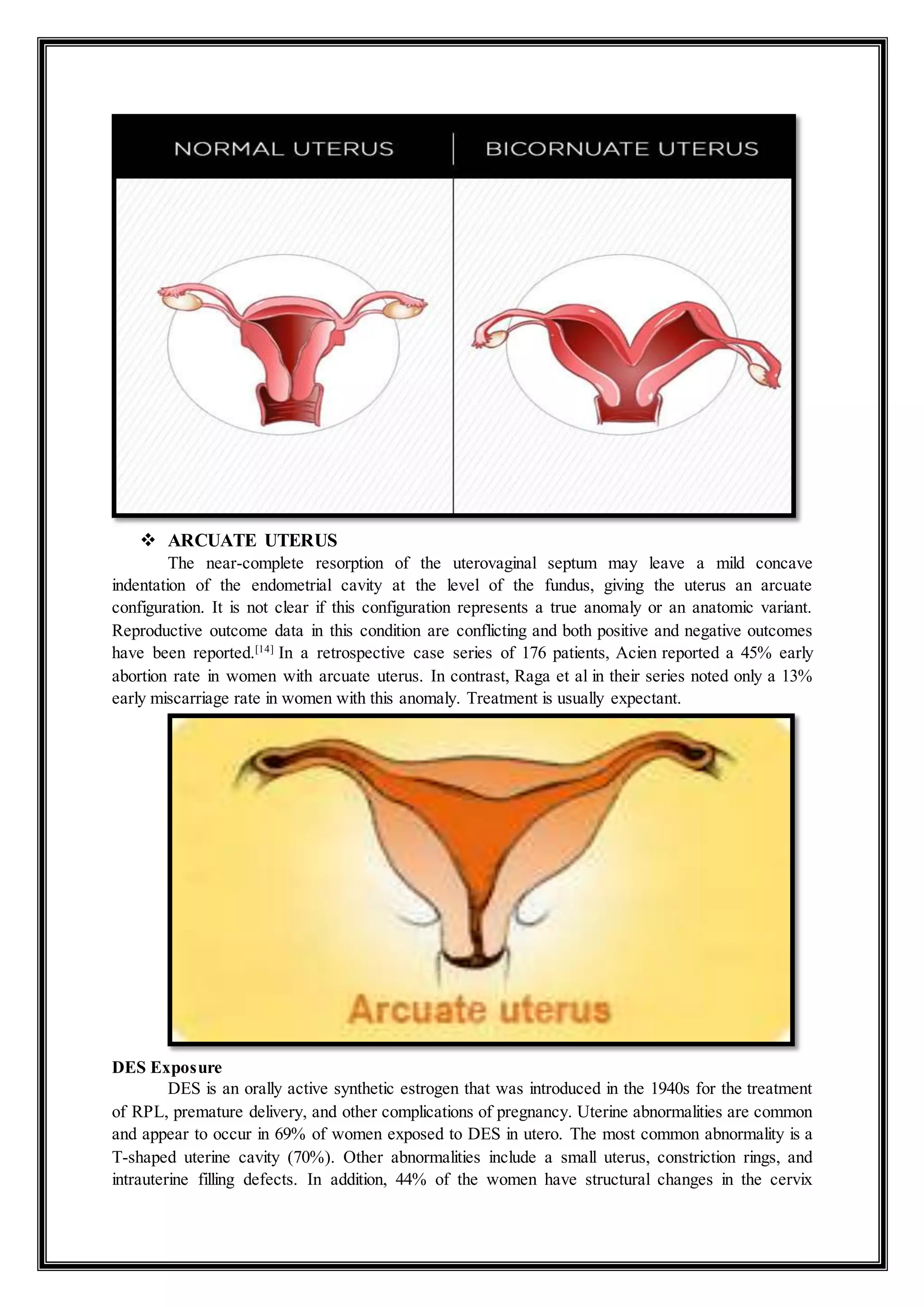  ARCUATE UTERUS
The near-complete resorption of the uterovaginal septum may leave a mild concave
indentation of the endometrial cavity at the level of the fundus, giving the uterus an arcuate
configuration. It is not clear if this configuration represents a true anomaly or an anatomic variant.
Reproductive outcome data in this condition are conflicting and both positive and negative outcomes
have been reported.[14]
In a retrospective case series of 176 patients, Acien reported a 45% early
abortion rate in women with arcuate uterus. In contrast, Raga et al in their series noted only a 13%
early miscarriage rate in women with this anomaly. Treatment is usually expectant.
DES Exposure
DES is an orally active synthetic estrogen that was introduced in the 1940s for the treatment
of RPL, premature delivery, and other complications of pregnancy. Uterine abnormalities are common
and appear to occur in 69% of women exposed to DES in utero. The most common abnormality is a
T-shaped uterine cavity (70%). Other abnormalities include a small uterus, constriction rings, and
intrauterine filling defects. In addition, 44% of the women have structural changes in the cervix
 