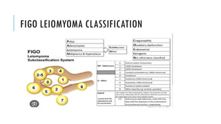 Myome Classification Uterine myoma........................ppt