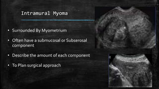 Intramural Myoma
• Surrounded By Myometrium
• Often have a submucosal or Subserosal
component
• Describe the amount of eac...