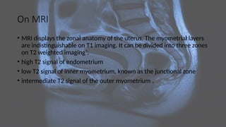 On MRI
• MRI displays the zonal anatomy of the uterus. The myometrial layers
are indistinguishable on T1 imaging. It can be divided into three zones
on T2 weighted imaging7
:
• high T2 signal of endometrium
• low T2 signal of inner myometrium, known as the junctional zone
• intermediate T2 signal of the outer myometrium .
 