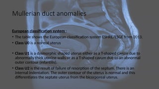 Mullerian duct anomalies
European classification system :
• The table shows the European classification system ESHRE/ESGE from 2013.
• Class U0 is a normal uterus
• Class U1 is a dysmorphic shaped uterus either as a T-shaped cavum due to
abnormally thick uterine walls or as a T-shaped cavum due to an abnormal
outer contour (infantilis).
• Class U2 is the result of failure of resorption of the septum. There is an
internal indentation. The outer contour of the uterus is normal and this
differentiates the septate uterus from the bicorporeal uterus.
 