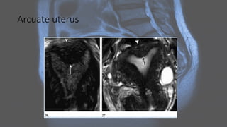 Arcuate uterus
 