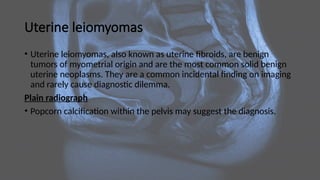 Uterine leiomyomas
• Uterine leiomyomas, also known as uterine fibroids, are benign
tumors of myometrial origin and are the most common solid benign
uterine neoplasms. They are a common incidental finding on imaging
and rarely cause diagnostic dilemma.
Plain radiograph
• Popcorn calcification within the pelvis may suggest the diagnosis.
 