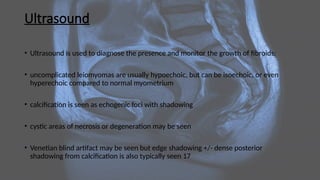 Ultrasound
• Ultrasound is used to diagnose the presence and monitor the growth of fibroids:
• uncomplicated leiomyomas are usually hypoechoic, but can be isoechoic, or even
hyperechoic compared to normal myometrium
• calcification is seen as echogenic foci with shadowing
• cystic areas of necrosis or degeneration may be seen
• Venetian blind artifact may be seen but edge shadowing +/- dense posterior
shadowing from calcification is also typically seen 17
 