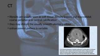 CT
• fibroids are usually seen as soft tissue density lesions and may exhibit
coarse peripheral or central calcification
• they may distort the usually smooth uterine contour
• enhancement pattern is variable
 